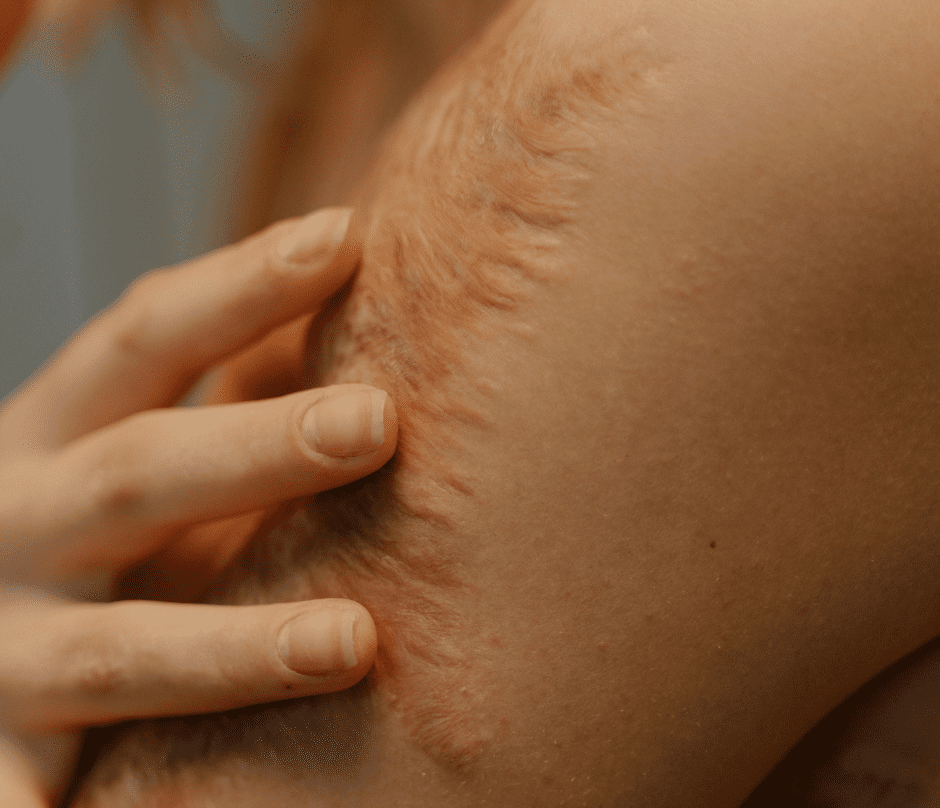 a close-up picture of a scar on the skin