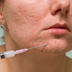 a woman gets acne treatment with a needle