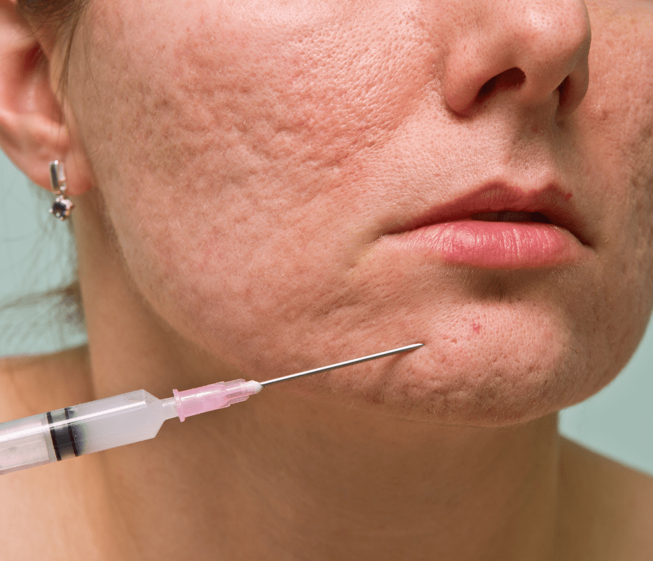 a woman gets acne treatment with a needle