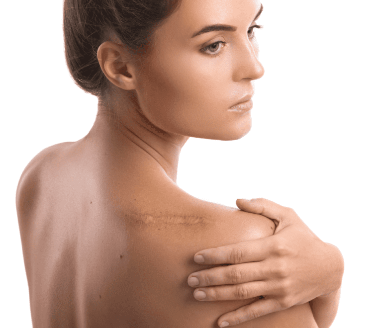 a woman with a shoulder scar