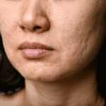 a woman with acne scars