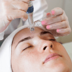 women are treated with microneedling