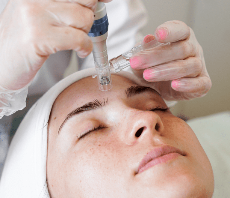 women are treated with microneedling