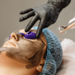 a patient undergoes hollywood laser peel