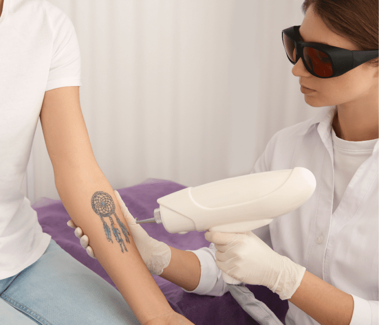 patient having a laser tattoo removal