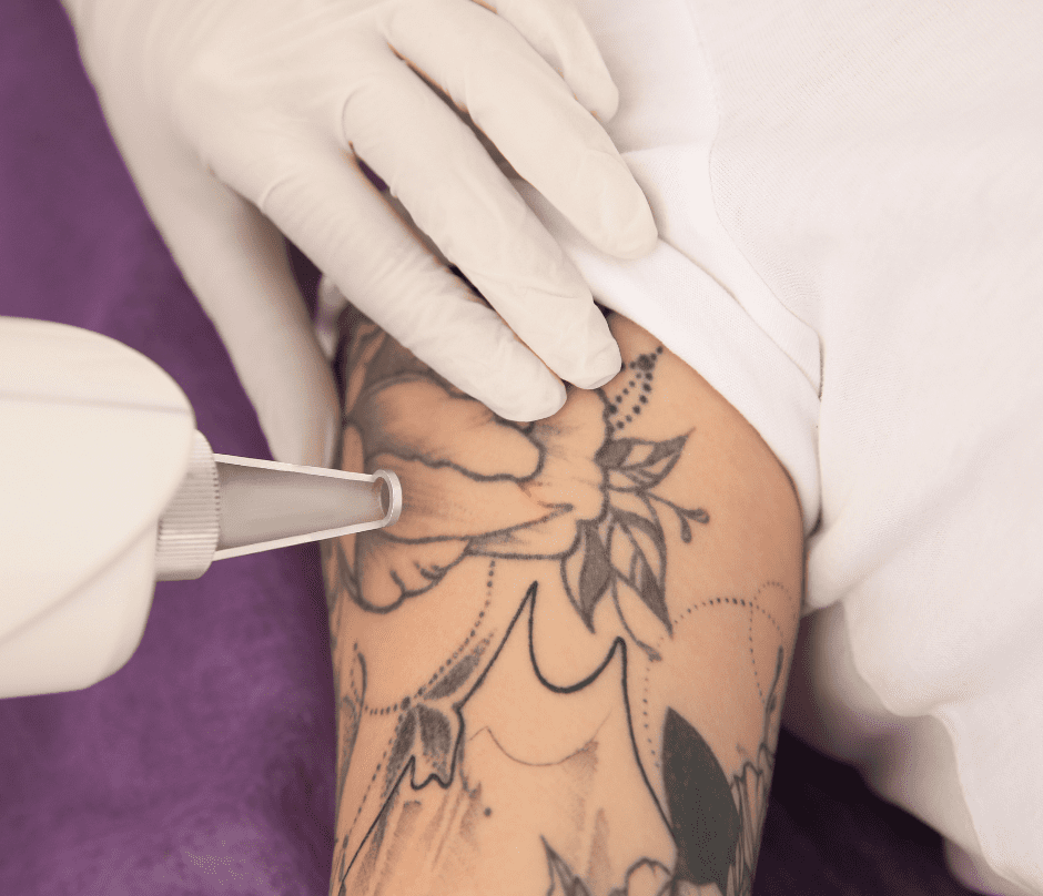 removing a tattoo using laser