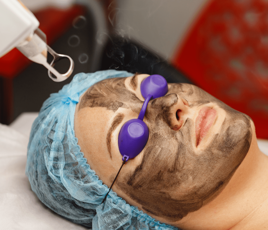 the hollywood laser peel is used on a woman