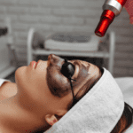female patient undergoes carbon laser facial treatment