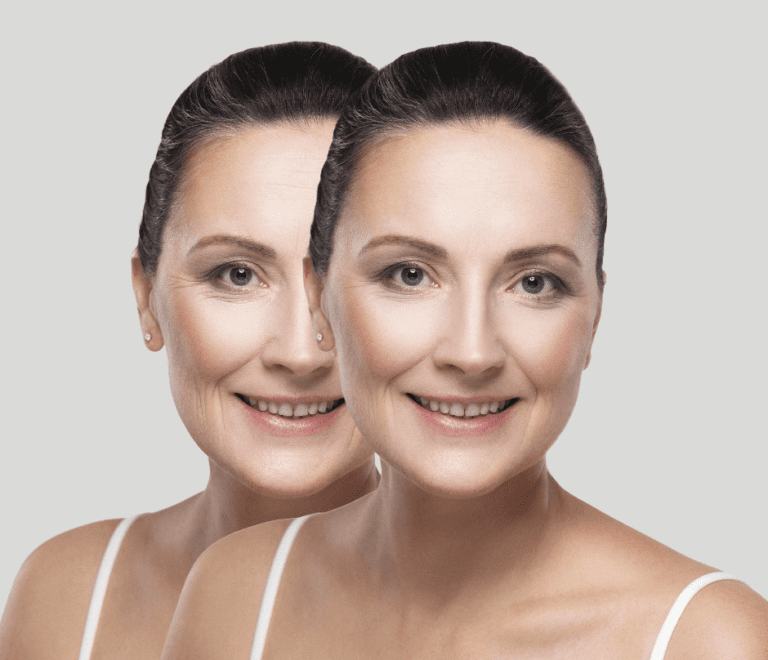 before and after of anti-aging procedure exosomes