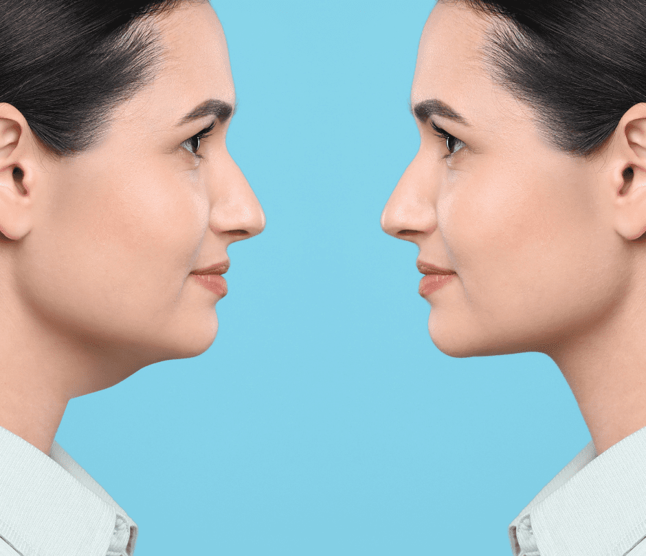 before and after of kybella treatment
