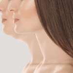 image of before and after of kybella