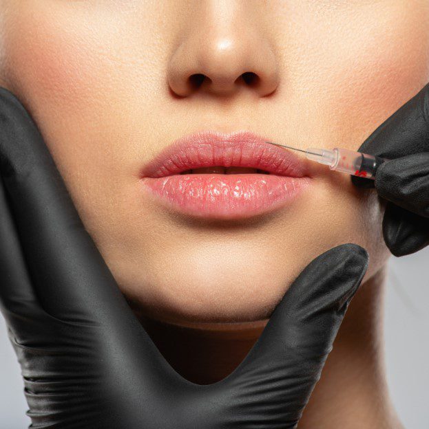 treating lip lines