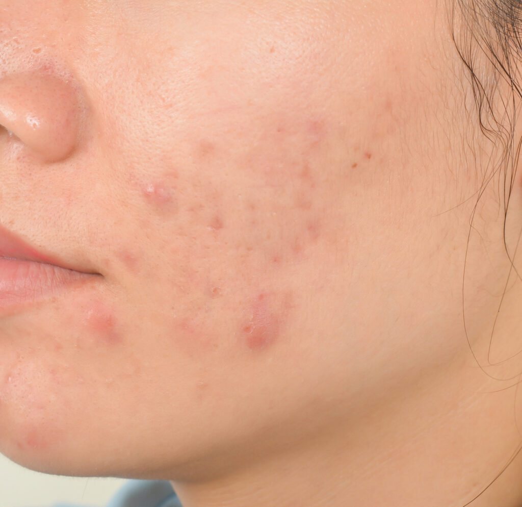 Scar from Acne on face
