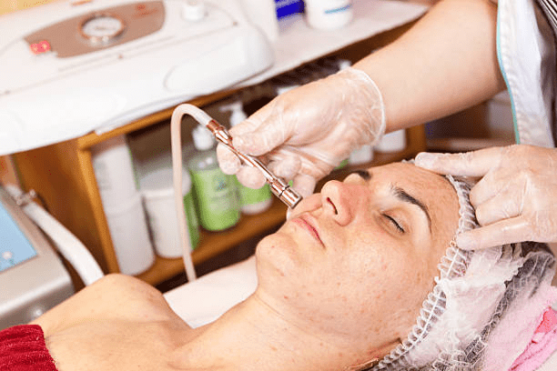 Microneedling with PRF for Acne Scars