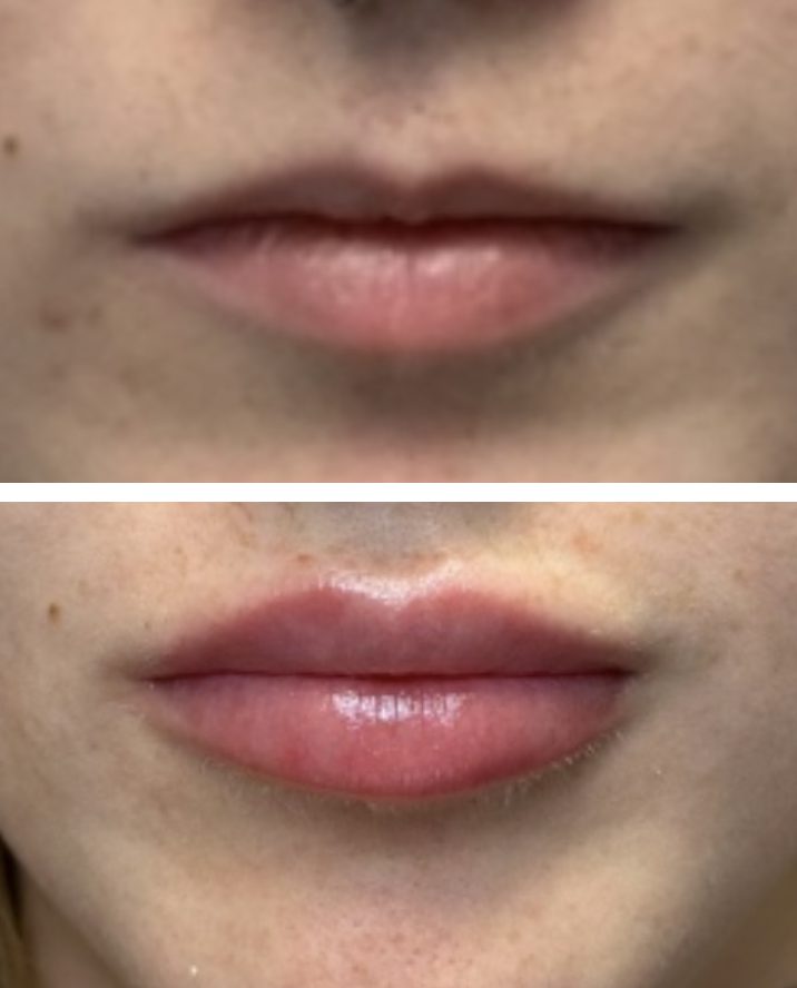 lip filler before and after