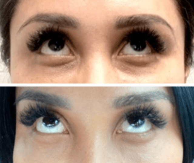 Eyes before and after