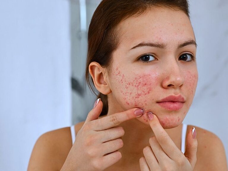 Acne all over face