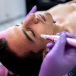 microneedling on face