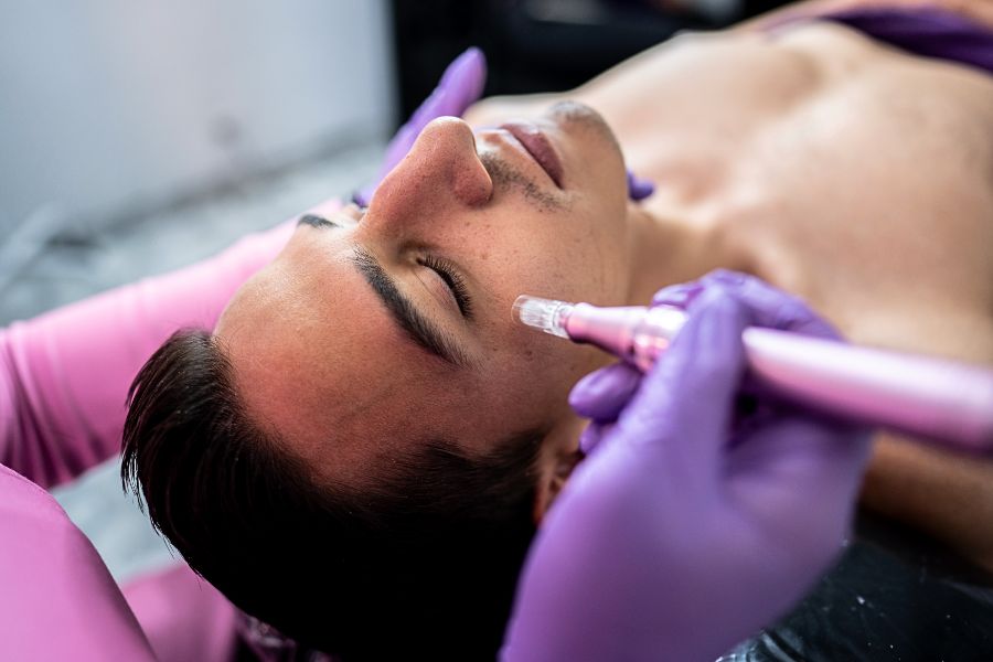 microneedling on face