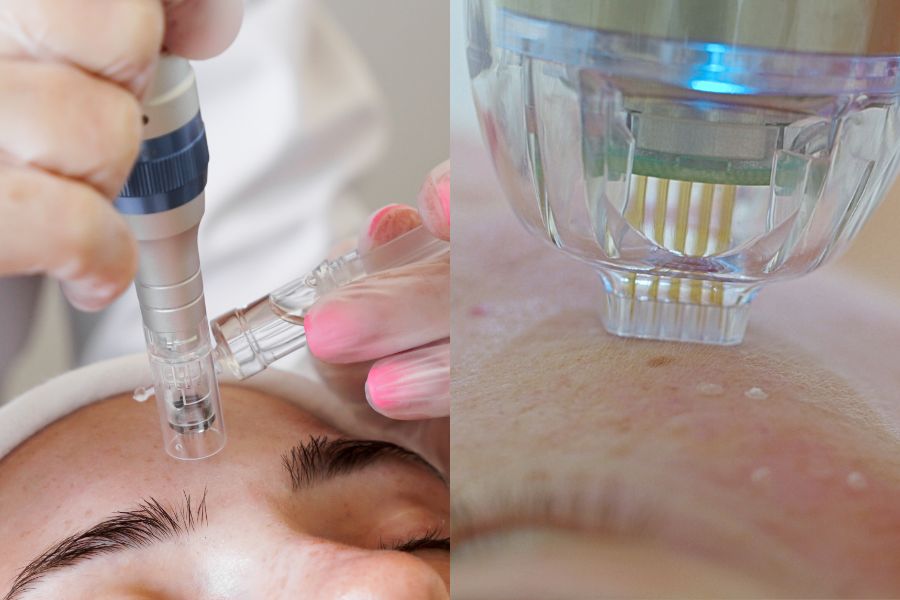 RF Microneedling vs microneedling alone