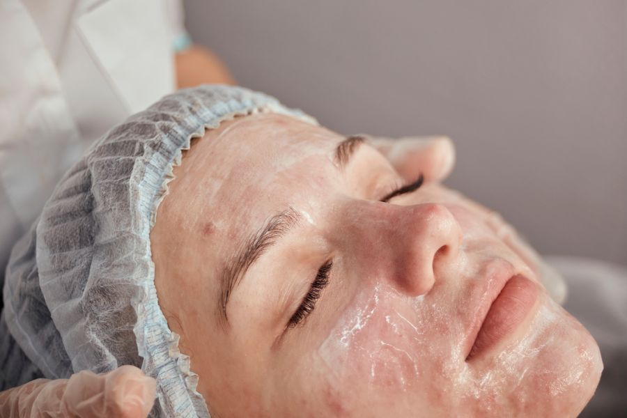 facials for acne