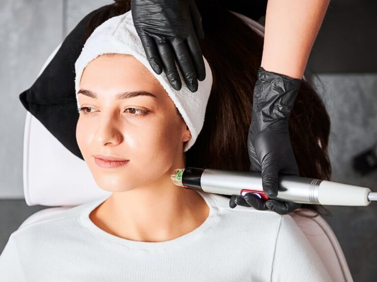 microneedling with RF