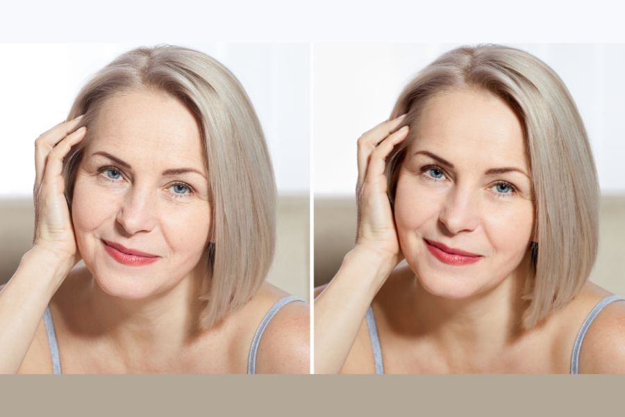 anti-aging treatment before and after