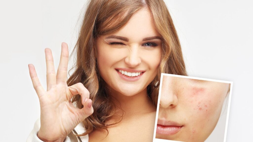 face will be okay with acne treatment at Saint Aesthetix