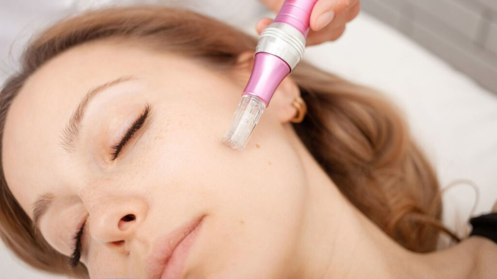 microneedling for acne-prone skin