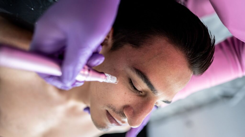 microneedling for men