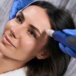 microneedling for normal skin