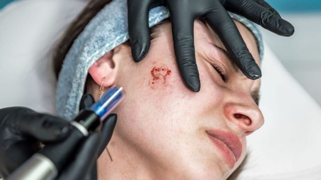 microneedling for sensitive skin