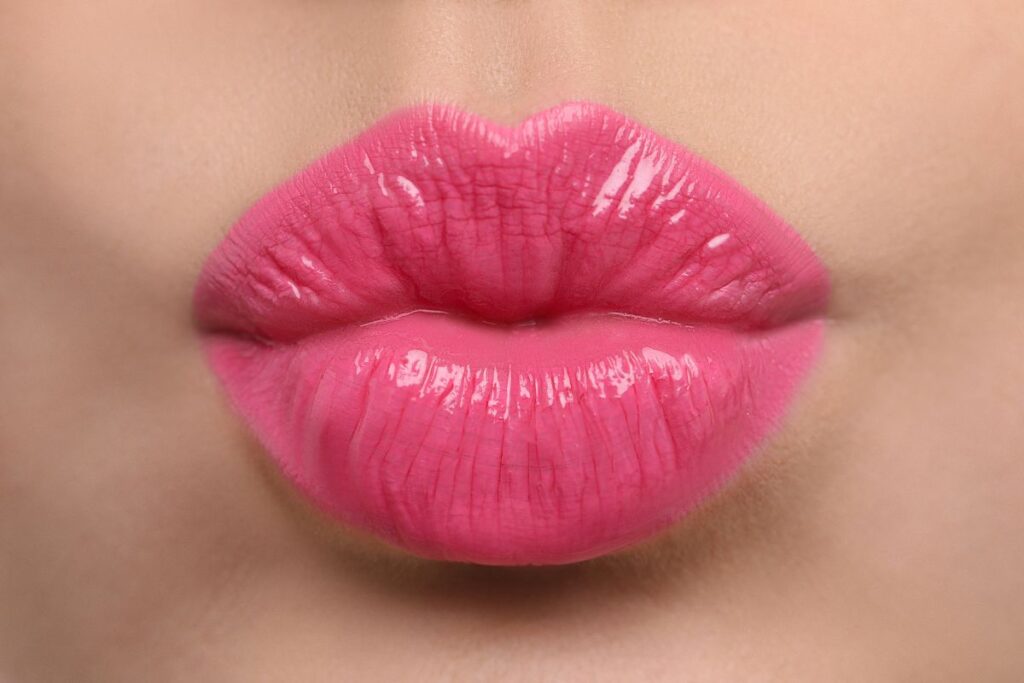 lip filler enhancement result