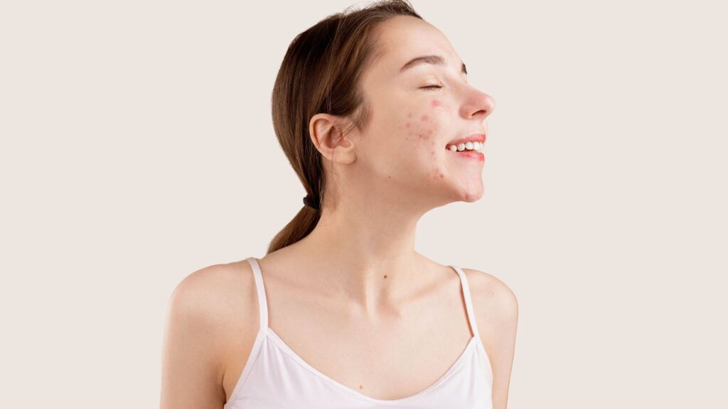 acne scars