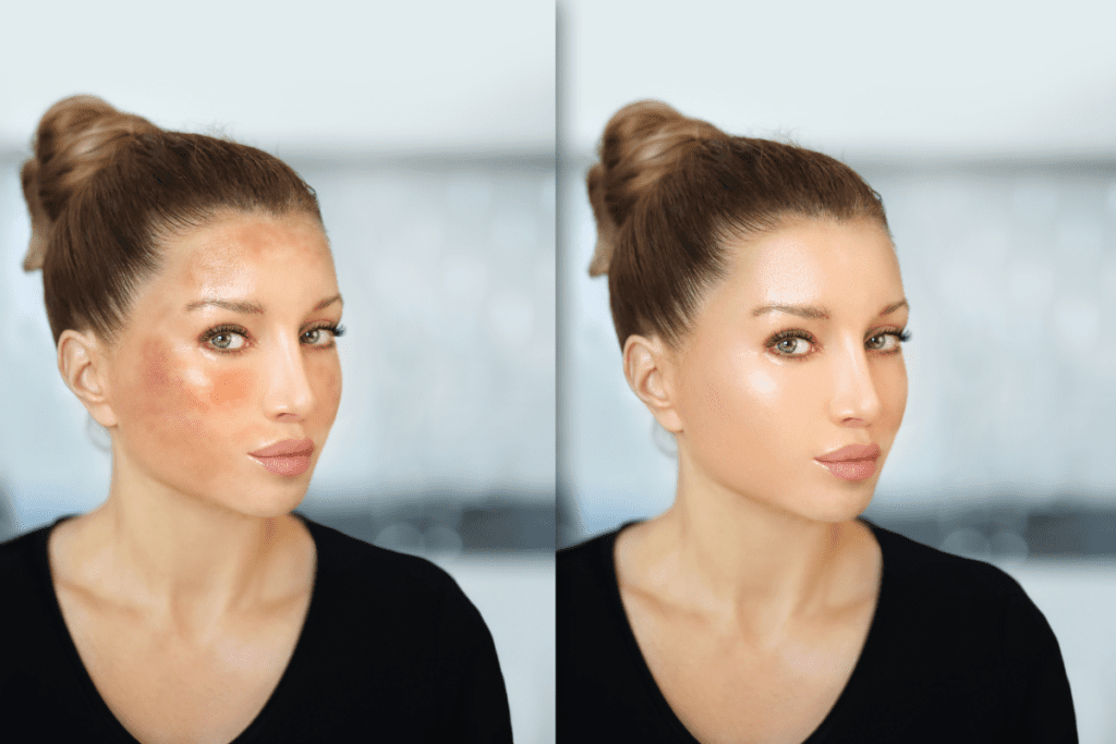 Before and after comparison of skin discoloration showing why melasma keeps coming back after using quick fix treatments.