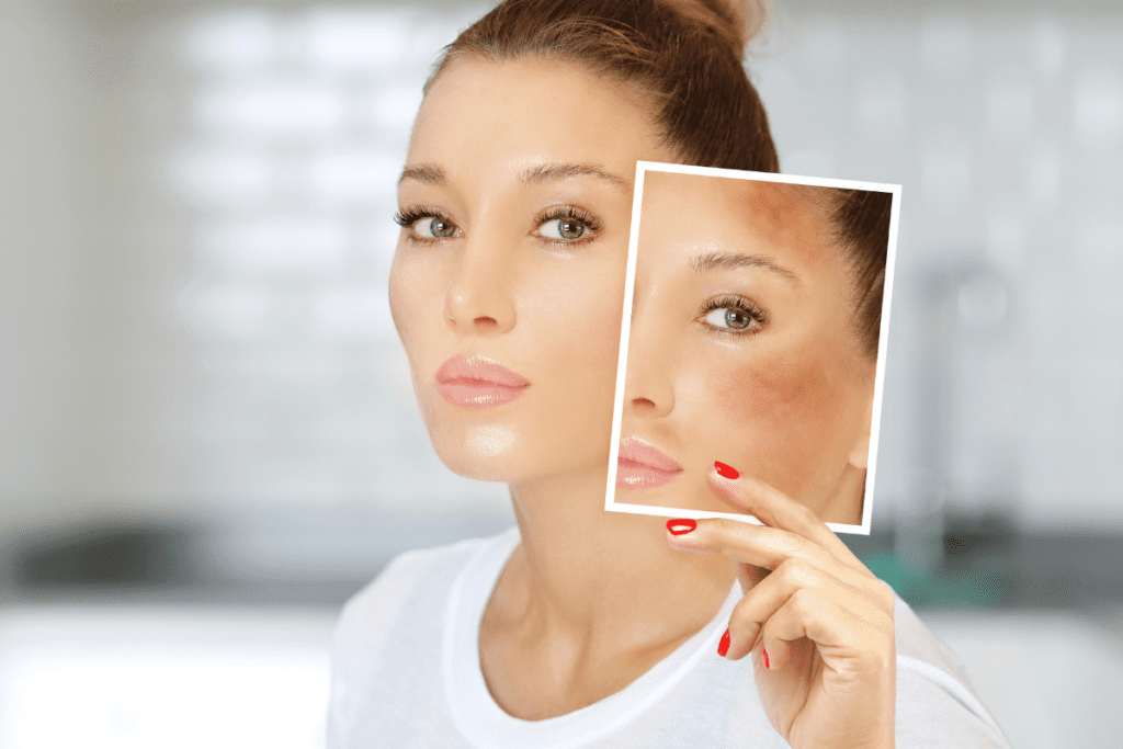 Woman holding a photo of her facial spots to illustrate why melasma keeps coming back due to poor skin barrier health.