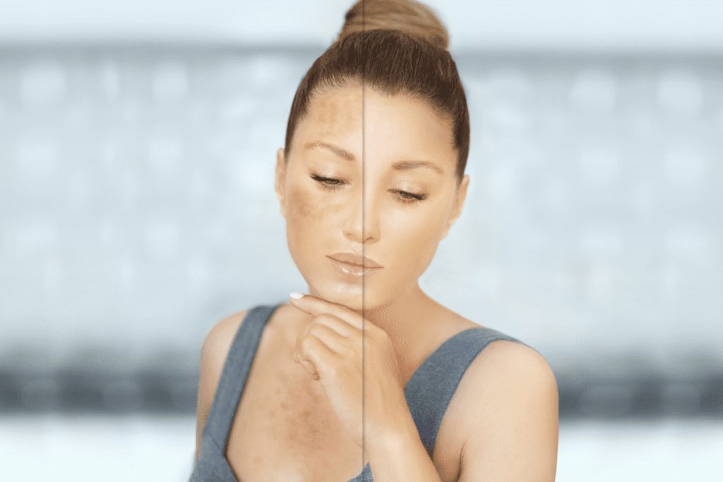 Split screen of facial pigmentation and clear skin demonstrating why melasma keeps coming back and how to take control.