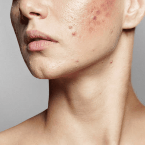 Acne Scars