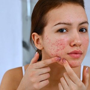 Acne all over face
