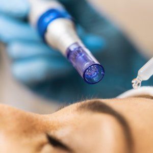 Microneedling with PRF