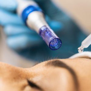 Microneedling with PRP
