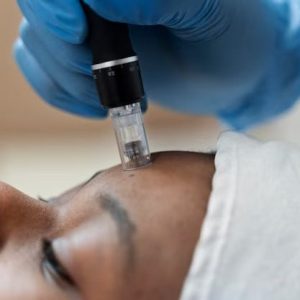 PRF microneedling done in the forehead
