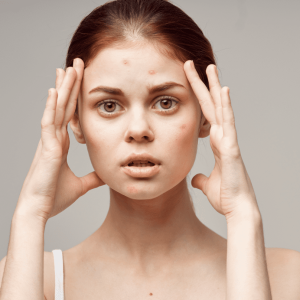 a woman with acne problem