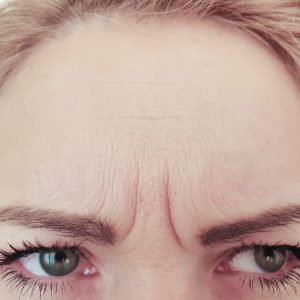 glabellar lines