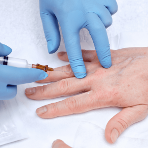 hand rejuvenation fillers