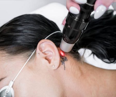tatoo removal